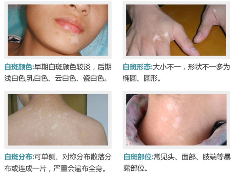 阜阳治疗白癜风医院的最新进展与选择